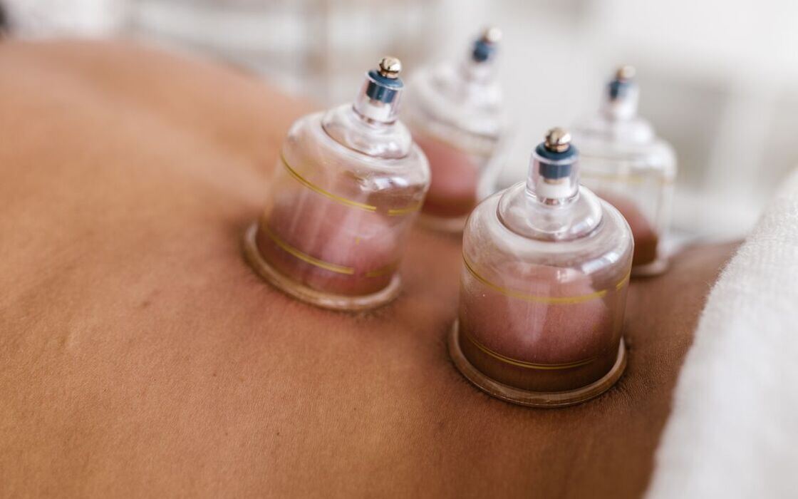 Cupping therapy — silicone cups applied along the back